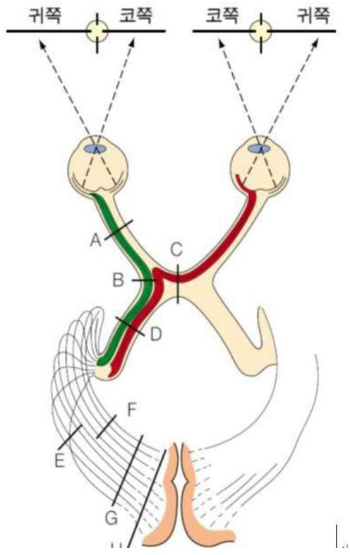 시각 경로의 해부학적 구조와 손상 부위별 시야 결손을 나타내는 도식도. A: 시신경, B: 시교차 외측, C: 시교차 중심, D: 시삭(Optic tract), E-H: 시방사 및 시각 피질 부위를 나타냄. 본 문제의 텍스트 내용과는 직접적인 연관성이 낮은 참고용 이미지로 보임.