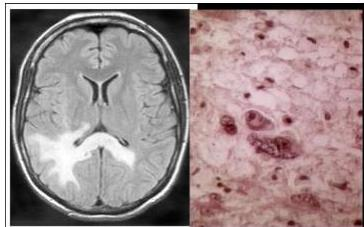 Brain MRI and Histopathology