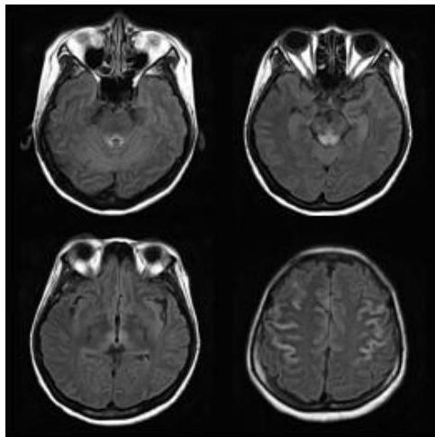 Brain MRI FLAIR axial images showing symmetrical high signal intensities in the periaqueductal gray matter, medial thalami, and around the third ventricle, consistent with Wernicke encephalopathy.