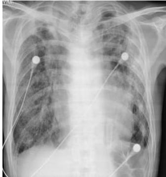 흉부 엑스선 사진: 양측 폐야 전반에 걸쳐 미만성 폐포 침윤(diffuse alveolar infiltration)이 관찰되며, 심비대 소견이 동반되어 있음.