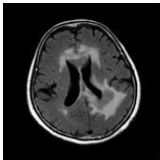 Axial FLAIR MRI: 뇌실 주위와 뇌량 부위에 광범위한 고신호강도의 부종 소견이 관찰됨.