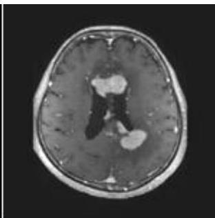 Axial T1-weighted Contrast Enhanced MRI: 뇌실 앞쪽과 뒤쪽 뇌실막을 따라 경계가 비교적 명확하고 강하게 조영증강되는 종괴가 관찰됨.