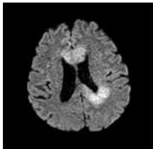 Axial DWI: 조영증강 부위와 일치하는 병변이 강한 고신호강도를 보여 세포 밀도가 높음을 시사함.