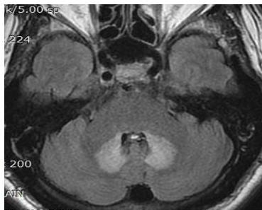 뇌 MRI FLAIR 축상면 영상에서 양측 소뇌 치상핵 부위에 대칭적인 고신호강도가 관찰됨.