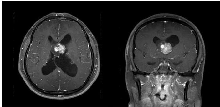 뇌 MRI T1 강조 조영증강 영상. 축상면(Axial)과 관상면(Coronal)에서 몬로공 부위에 위치한 강하게 조영증강되는 종괴가 관찰되며, 이로 인해 측뇌실이 확장된 뇌수종 소견이 동반됨.