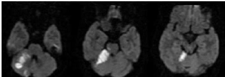 MRI DWI