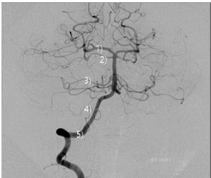 Angiography