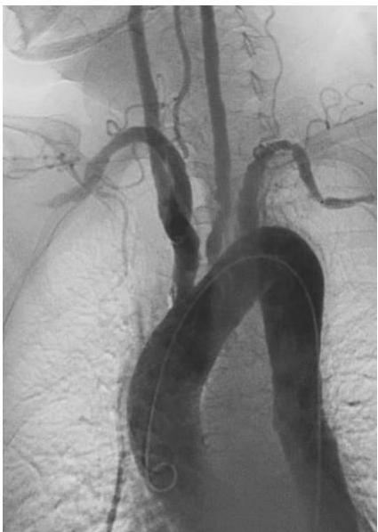 대동맥궁 혈관조영술 사진. 대동맥궁에서 기시하는 왼쪽 쇄골하동맥(left subclavian artery)과 왼쪽 총경동맥(left common carotid artery) 부위에 심한 협착과 혈관벽의 불규칙성이 관찰됨.
