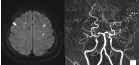 뇌 MRI 및 MRA
