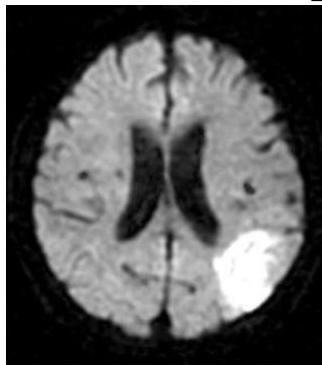 뇌 MRI DWI 영상에서 좌측 두정-후두엽 부위에 고신호강도의 급성 병변이 관찰됨
