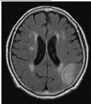 뇌 MRI FLAIR 영상에서 동일 부위에 부종을 동반한 고신호강도 병변이 관찰됨