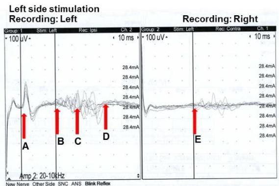 Blink reflex waveform
