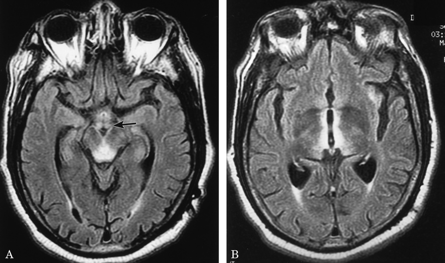 뇌 MRI T2/FLAIR 영상: 시상(thalamus) 내측부와 제3뇌실 주위, 중뇌 수도관 주위(periaqueductal area)에 대칭적인 고신호강도가 관찰됨.