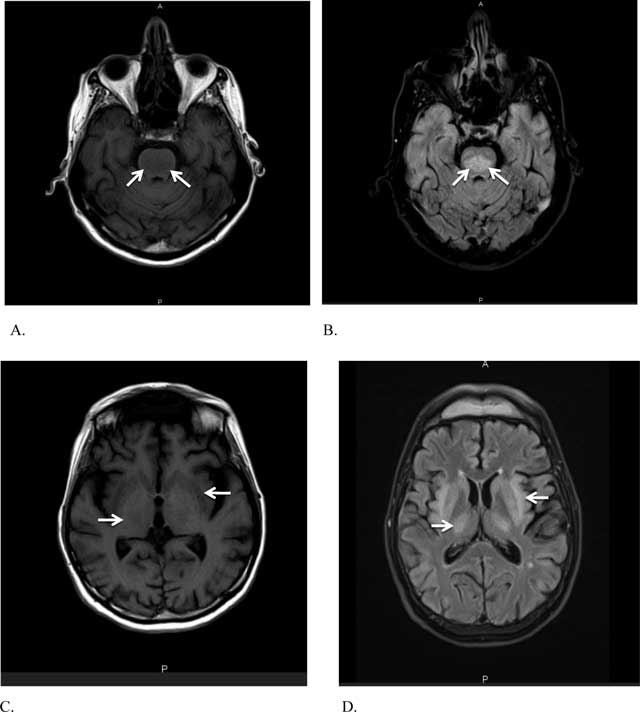 Brain MRI showing extrapontine myelinolysis (EPM) with symmetrical high signal intensities in the bilateral basal ganglia (caudate and putamen) and thalamus.
