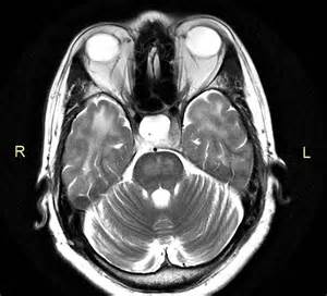 Brain MRI Diffusion Weighted Imaging (DWI) showing a bright high-signal intensity lesion in the central pons, characteristic of central pontine myelinolysis.