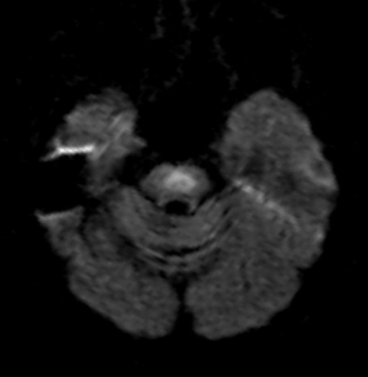 Brain MRI T2-weighted or FLAIR image showing a symmetrical hyperintense lesion in the central basis pontis with sparing of the peripheral tegmentum and corticospinal tracts.