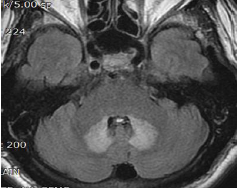 Typical MRI findings of Metronidazole-induced encephalopathy.
