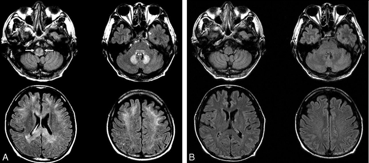Brain MRI showing bilateral symmetric high signal intensities in the dentate nuclei of the cerebellum on FLAIR/T2 images.