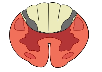 Anterior spinal syndrome