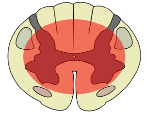 Central spinal syndrome