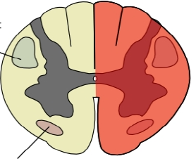 Brown-Sequard syndrome