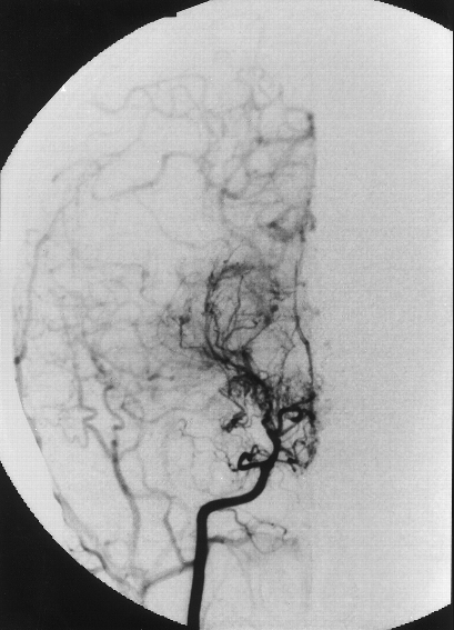 Digital Subtraction Angiography (DSA) - Right ICA injection showing 'puff of smoke' appearance of collateral vessels.