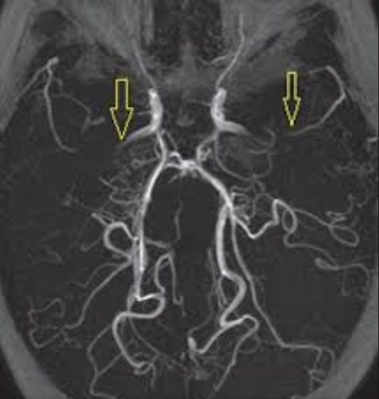 Digital Subtraction Angiography (DSA) - Left ICA injection showing characteristic moyamoya vessels at the base of the brain.