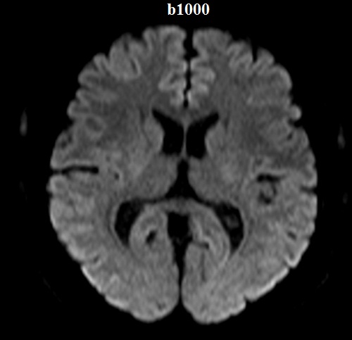 MRI T2-weighted axial image showing multiple small flow voids in the basal ganglia area, suggestive of moyamoya vessels.