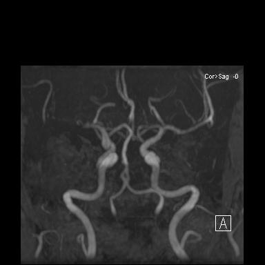 MRA showing severe stenosis/occlusion of both distal internal carotid arteries and proximal middle/anterior cerebral arteries with compensatory collateral vessels.