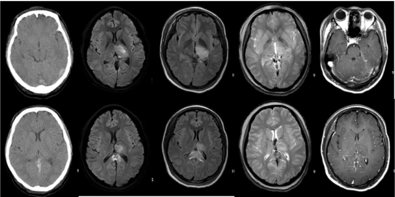 Brain MRI (DWI)
