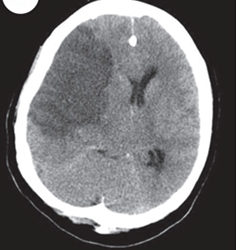 뇌 CT 영상: 우측 중대뇌동맥(MCA) 영역에 광범위한 저음영(hypodensity) 소견이 보이며, 뇌부종으로 인해 뇌실이 압박되고 정중선이 좌측으로 약간 밀려나 있는 모습이다.
