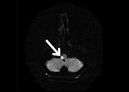 MRI DWI: 오른쪽 외측 연수에 고신호강도의 병변이 관찰되어 우측 외측 연수 증후군(Lateral medullary infarction)을 시사함.