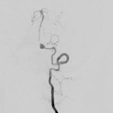 MRA: 오른쪽 척추동맥(VA)의 협착 및 박리 동맥류(Dissecting aneurysm) 소견이 관찰됨.