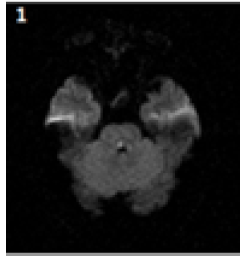 MRI T2/FLAIR: 우측 MLF 부위의 국소적 병변을 보여주는 축상면 영상