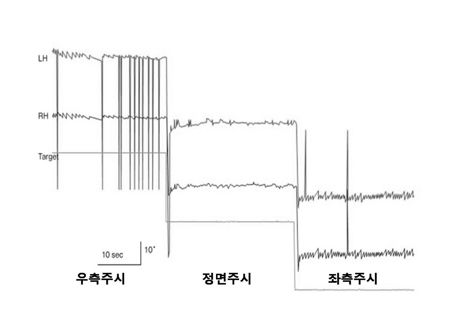 비디오 안진검사(VNG) 결과: 좌우 주시 시 안구의 위치를 유지하지 못하고 중앙으로 서서히 흐르다가 다시 외측으로 튀는 주시유발안진(Gaze-evoked nystagmus) 소견.