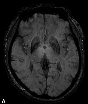 뇌 MRI SWI 영상