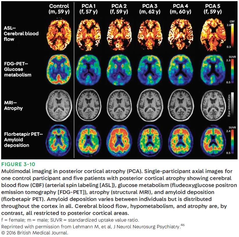 Amyloid PET 판독 시 주요 관심 영역(ROI) 설명도