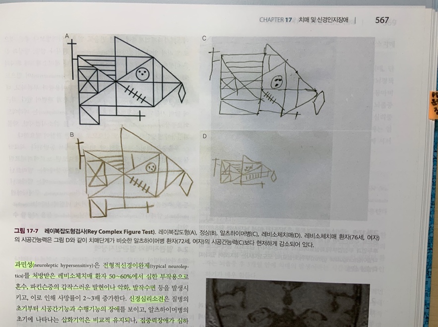 DLB와 AD의 신경심리검사 비교 그래프