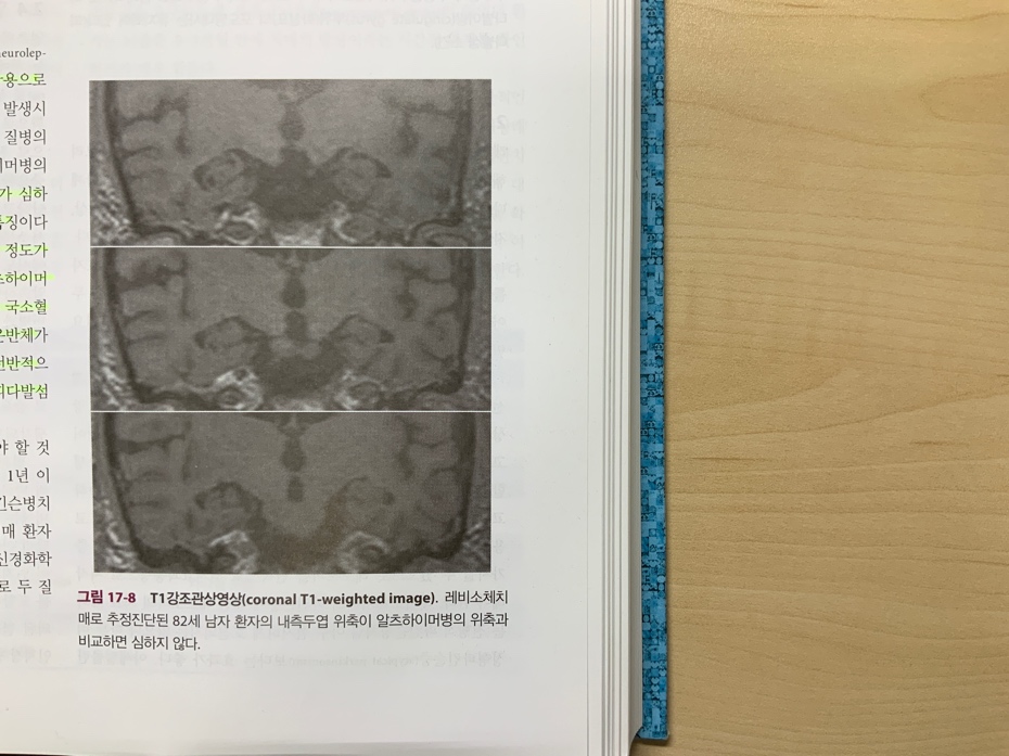 DLB 환자의 뇌 MRI 소견 - 내측 측두엽 보존