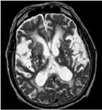 MRI T2/FLAIR axial view showing diffuse periventricular white matter hyperintensities consistent with small vessel disease.