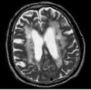 MRI T2/FLAIR axial view at a higher level showing extensive deep white matter signal changes.