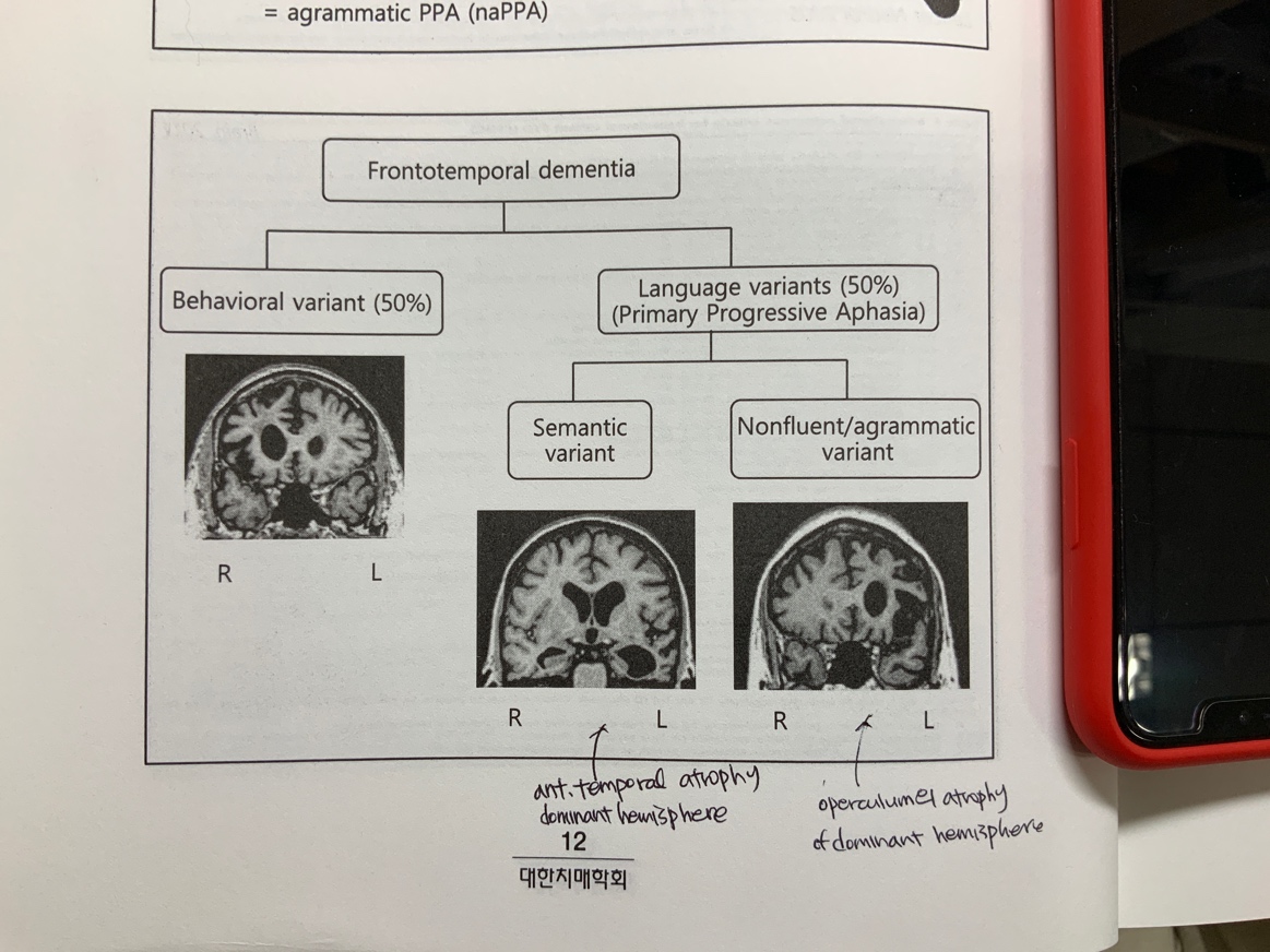 뇌 MRI 소견