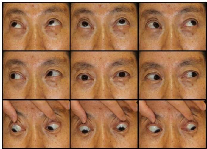 안구운동범위 사진