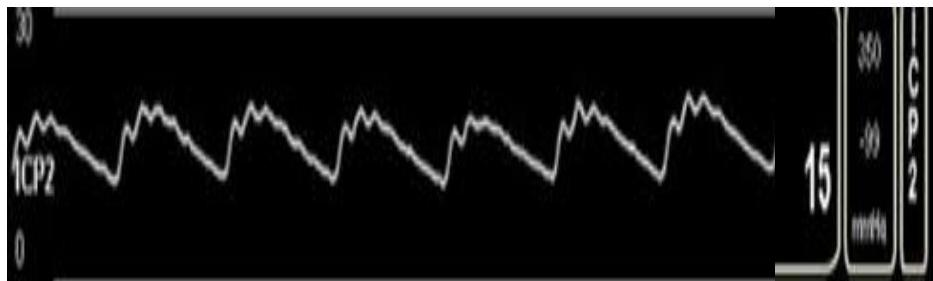 ICU Monitor ICP Waveform