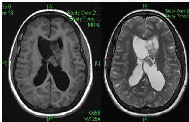 뇌 MRI