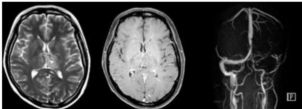 Brain MRI and MRV