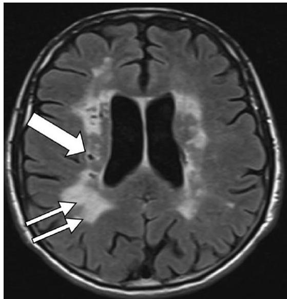 뇌 MRI FLAIR 축상면 영상. 양측 뇌실 주위와 심부 백질에 광범위한 고신호강도가 관찰되며, 우측 기저핵 및 백질 부위에 다발성 열공 뇌경색(화살표)이 동반되어 있음.