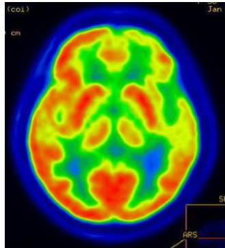 Brain FDG-PET