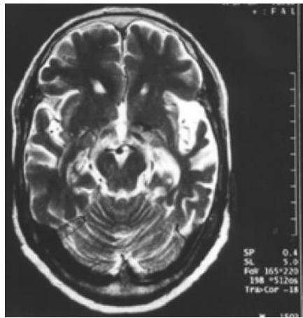 뇌 MRI 축상면(Axial) T2 강조 영상. 좌측 측두엽(Temporal lobe) 부위의 현저한 뇌실 확장과 뇌회 위축이 관찰됨.