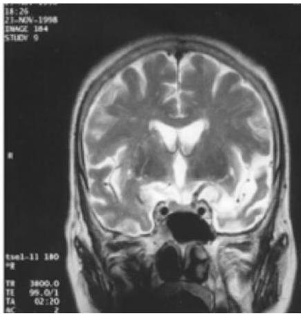 뇌 MRI 관상면(Coronal) T2 강조 영상. 좌측 전측두엽(Anterior temporal lobe)의 심한 위축과 이로 인한 측뇌실 하각(Inferior horn)의 확장이 비대칭적으로 뚜렷함.